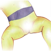 KLEBER BEBE OMBILICAL - CEINTURE HERNIAIRE...